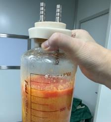 博尔塔拉水动力吸脂手术要做多久？